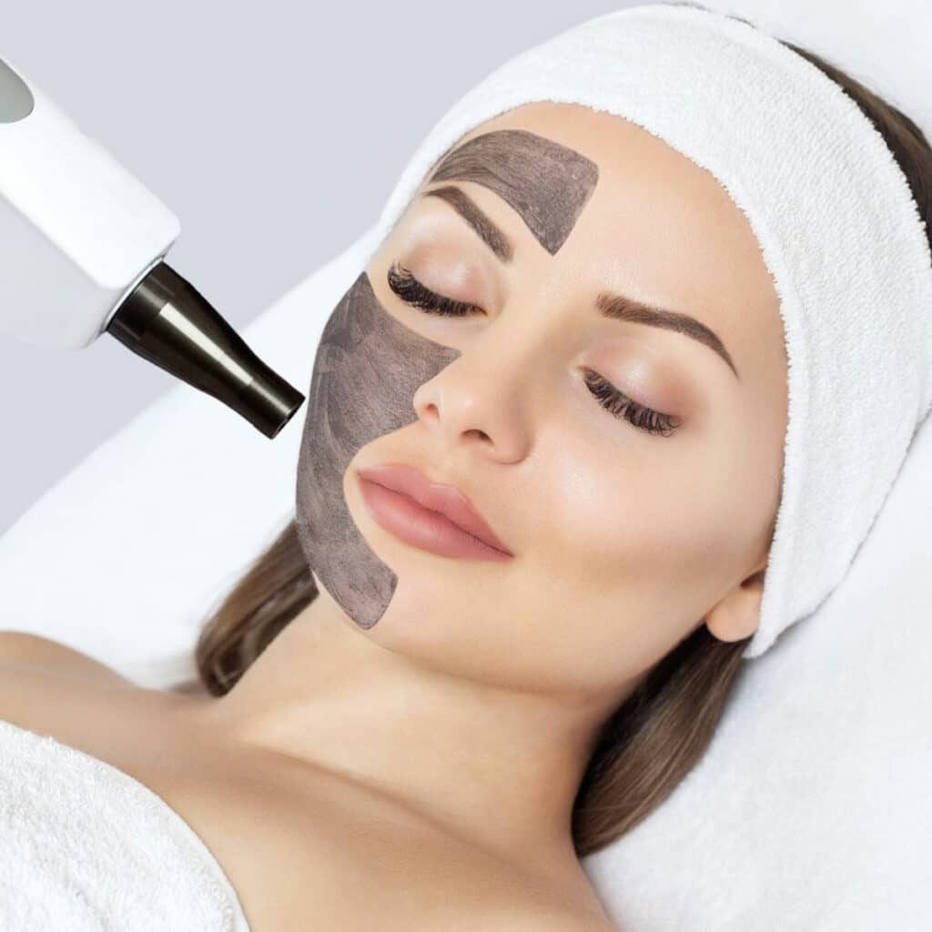 traitement hollywood carbon peel