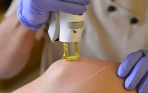 Épilation laser ou cire : quelle méthode est la meilleure ?